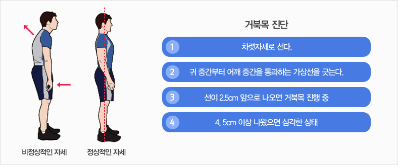 거북목 진단의 1. 차렷자세로선다 / 2. 귀 중간부터 어깨 중간을 통과하는 가상선을 긋는다. / 3. 선이 2.5cm 앞으로 나오면 거북목 진행 중 / 4. 4.5cm 이상 나왔으면 심각한 상태