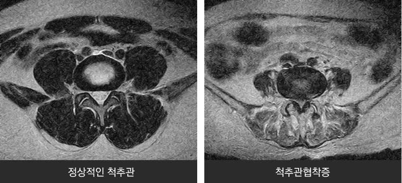 정상적인 척추관, 척추관협착증 의 이미지