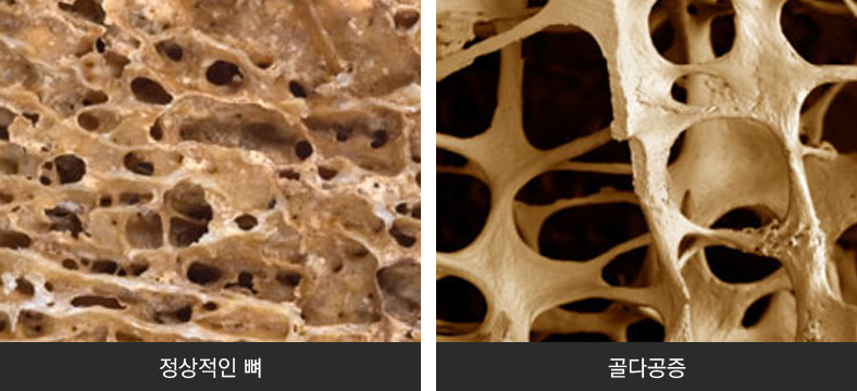 정상적인 뼈, 골다공증의 이미지