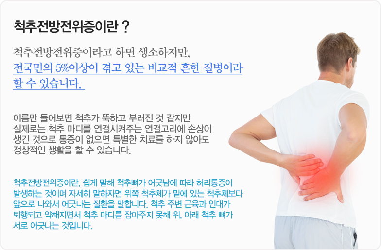 척추전방전위증이란 ? 척추전방전위증이라고 하면 생소하지만, 전국민의 5%이상이 겪고 있는 비교적 흔한 질병이라 할 수 있습니다. 이름만 들어보면 척추가 뚝하고 부러진 것 같지만 실제로는 척추 마디를 연결시켜주는 연결고리에 손상이 생긴 것으로 통증이 없으면 특별한 치료를 하지 않아도 정상적인 생활을 할 수 있습니다. 척추전방전위증이란, 쉽게 말해 척추뼈가 어긋남에 따라 허리통증이 발생하는 것이며 자세히 말하자면 위쪽 척추체가 밑에 있는 척추체보다 앞으로 나와서 어긋나는 질환을 말합니다. 척추 주변 근육과 인대가 퇴행되고 약해지면서 척추 마디를 잡아주지 못해 위, 아래 척추 뼈가 서로 어긋나는 것입니다.