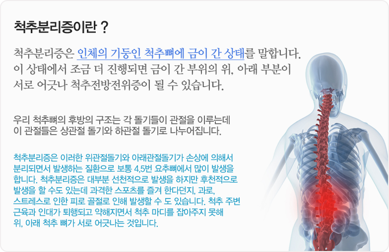 척추분리증이란 ? 척추분리증은 인체의 기둥인 척추뼈에 금이 간 상태를 말합니다. 이 상태에서 조금 더 진행되면 금이 간 부위의 위, 아래 부분이 서로 어긋나 척추전방전위증이 될 수 있습니다. 우리 척추뼈의 후방의 구조는 각 돌기들이 관절을 이루는데 이 관절들은 상관절 돌기와 하관절 돌기로 나누어집니다. 척추분리증은 이러한 위관절돌기와 아래관절돌기가 손상에 의해서 분리되면서 발생하는 질환으로 보통 4,5번 요추뼈에서 많이 발생을 합니다. 척추분리증은 대부분 선천적으로 발생을 하지만 후천적으로 발생을 할 수도 있는데 과격한 스포츠를 즐겨 한다던지, 과로, 스트레스로 인한 피로 골절로 인해 발생할 수 도 있습니다. 척추 주변 근육과 인대가 퇴행되고 약해지면서 척추 마디를 잡아주지 못해 위, 아래 척추 뼈가 서로 어긋나는 것입니다.