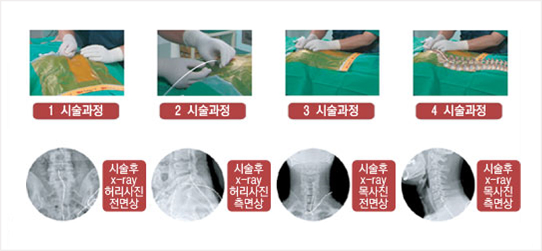 시술과정 - 시술후 x-ray 허리사진 전명상, 시술후 x-ray 허리사진 측면상, 시술 후 x-ray 목사진 전면상, 시술후 x-ray 목사진 측면상의 이미지