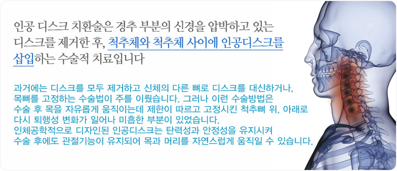 인공 디스크 치환술은 경추 부분의 신경을 압박하고 있는 디스크를 제거한 후, 척추체와 척추체 사이에 인공디스크를 삽입하는 수술적 치료입니다.과거에는 디스크를 모두 제거하고 신체의 다른 뼈로 디스크를 대신하거나,목뼈를 고정하는 수술법이 주를 이뤘습니다. 그러나 이런 수술방법은 수술 후 목을 자유롭게 움직이는데 제한이 따르고 고정시킨 척추뼈 위, 아래로 다시 퇴행성 변화가 일어나 미흡한 부분이 있었습니다. 인체공학적으로 디자인된 인공디스크는 탄력성과 안정성을 유지시켜 수술 후에도 관절기능이 유지되어 목과 머리를 자연스럽게 움직일 수 있습니다.