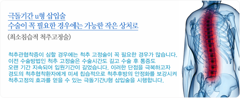 극돌기간 u형 삽입술수술이 꼭 필요한 경우에는 가능한 작은 상처로(최소침습적 척추고정술) - 척추관협착증이 심할 경우에는 척추 고정술이 꼭 필요한 경우가 많습니다. 이전 수술방법인 척추 고정술은 수술시간도 길고 수술 후 통증도 오랜 기간 지속되어 입원기간이 길었습니다. 이러한 단점을 극복하고자 경도의 척추협착환자에게 미세 칩습적으로 척추후방의 안정화를 보강시켜 척추고정의 효과를 얻을 수 있는 극돌기간U형 삽입술을 시행합니다.