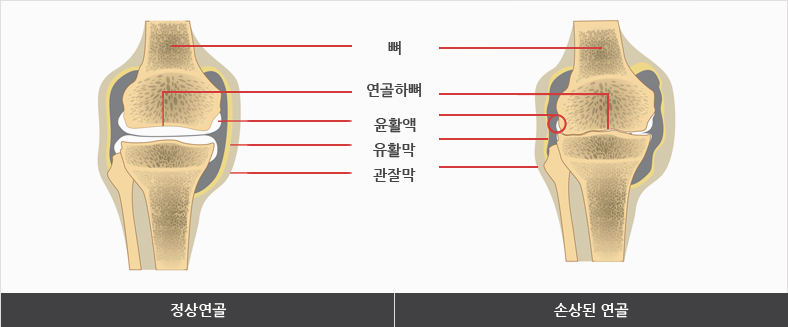 정상연골과 손상된 연골의 뼈, 연골하뼈, 윤활액, 유활막, 관잘막 의 이미지