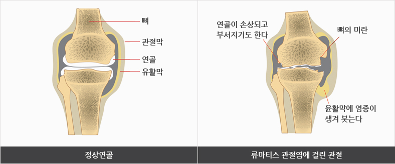 정상연골의 뼈, 관절막, 연골, 유활막 / 류마티스 관절염에 걸린 관절의 연골이손상되고 부석지기도한다, 뼈의 미란, 윤활막에 염증이 생겨 붓는다의 이미지