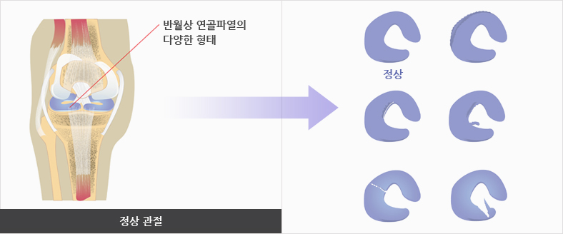 반월상 연골파열의 다양한 형태의 정상 관절 이미지