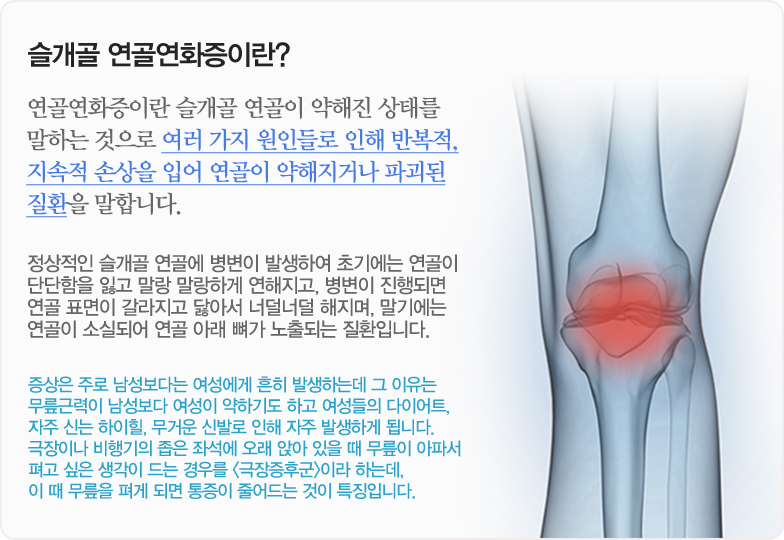 슬개골 연골연화증이란? 연골연화증이란 슬개골 연골이 약해진 상태를 말하는 것으로 여러 가지 원인들로 인해 반복적,지속적 손상을 입어 연골이 약해지거나 파괴된 질환을 말합니다.정상적인 슬개골 연골에 병변이 발생하여 초기에는 연골이 단단함을 잃고 말랑 말랑하게 연해지고, 병변이 진행되면 연골 표면이 갈라지고 닳아서 너덜너덜 해지며, 말기에는 연골이 소실되어 연골 아래 뼈가 노출되는 질환입니다. 증상은 주로 남성보다는 여성에게 흔히 발생하는데 그 이유는 무릎근력이 남성보다 여성이 약하기도 하고 여성들의 다이어트, 자주 신는 하이힐, 무거운 신발로 인해 자주 발생하게 됩니다. 극장이나 비행기의 좁은 좌석에 오래 앉아 있을 때 무릎이 아파서 펴고 싶은 생각이 드는 경우를 <극장증후군>이라 하는데, 이 때 무릎을 펴게 되면 통증이 줄어드는 것이 특징입니다.