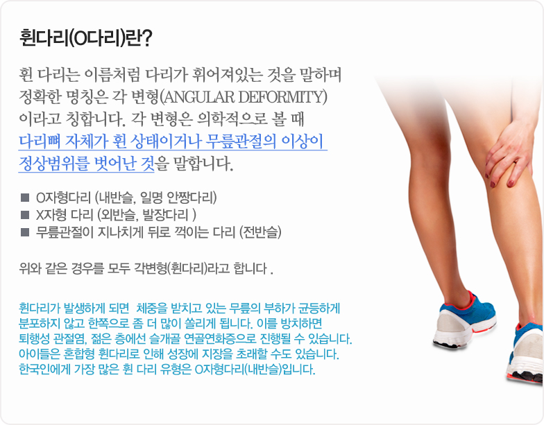 휜다리(O다리)란? 휜 다리는 이름처럼 다리가 휘어져있는 것을 말하며 정확한 명칭은 각 변형(angular deformity) 이라고 칭합니다. 각 변형은 의학적으로 볼 때 다리뼈 자체가 휜 상태이거나 무릎관절의 이상이 정상범위를 벗어난 것을 말합니다. O자형다리(내반슬, 일명 안짱다리), X자형 다리 (외반슬, 발장다리 ), 무릎관절이 지나치게 뒤로 꺽이는 다리 (전반슬) - 위와 같은 경우를 모두 각변형(휜다리)라고 합니다. 휜다리가 발생하게 되면  체중을 받치고 있는 무릎의 부하가 균등하게 분포하지 않고 한쪽으로 좀 더 많이 쏠리게 됩니다. 이를 방치하면 퇴행성 관절염, 젊은 층에선 슬개골 연골연화증으로 진행될 수 있습니다. 아이들은 혼합형 휜다리로 인해 성장에 지장을 초래할 수도 있습니다. 한국인에게 가장 많은 휜 다리 유형은 O자형다리(내반슬)입니다.