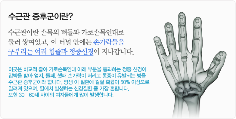 수근관 증후군이란? 수근관이란 손목의 뼈들과 가로손목인대로 둘러 쌓여있고, 이 터널 안에는 손가락들을 구부리는 여러 힘줄과 정중신경이 지나갑니다. 이곳은 비교적 좁아 가로손목인대 아래 부분을 통과하는 정중 신경이 압박을 받아 엄지, 둘째, 셋째 손가락이 저리고 통증이 유발되는 병을 수근관 증후군이라 합니다. 평생 이 질환에 걸릴 확률이 50% 이상으로 알려져 있으며, 팔에서 발생하는 신경질환 중 가장 흔합니다. 또한 30-60세 사이의 여자들에게 많이 발생합니다.