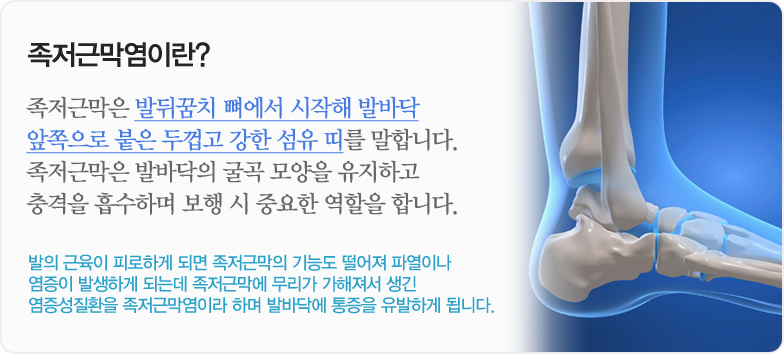 족저근막염이란? 족저근막은 발뒤꿈치 뼈에서 시작해 발바닥 앞쪽으로 붙은 두껍고 강한 섬유 띠를 말합니다. 족저근막은 발바닥의 굴곡 모양을 유지하고 충격을 흡수하며 보행 시 중요한 역할을 합니다. 발의 근육이 피로하게 되면 족저근막의 기능도 떨어져 파열이나 염증이 발생하게 되는데 족저근막에 무리가 가해져서 생긴 염증성질환을 족저근막염이라 하며 발바닥에 통증을 유발하게 됩니다.