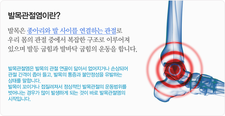 발목관절염이란? 발목은 종아리와 발 사이를 연결하는 관절로 우리 몸의 관절 중에서 복잡한 구조로 이루어져 있으며 발등 굽힘과 발바닥 굽힘의 운동을 합니다. 발목관절염은 발목의 관절 연골이 닳아서 없어지거나 손상되어 관절 간격이 좁아 들고, 발목의 통증과 불안정성을 유발하는 상태를 말합니다. 발목이 꼬이거나 접질려져서 정상적인 발목관절의 운동범위를 벗어나는 경우가 많이 발생하게 되는 것이 바로 발목관절염의 시작입니다.