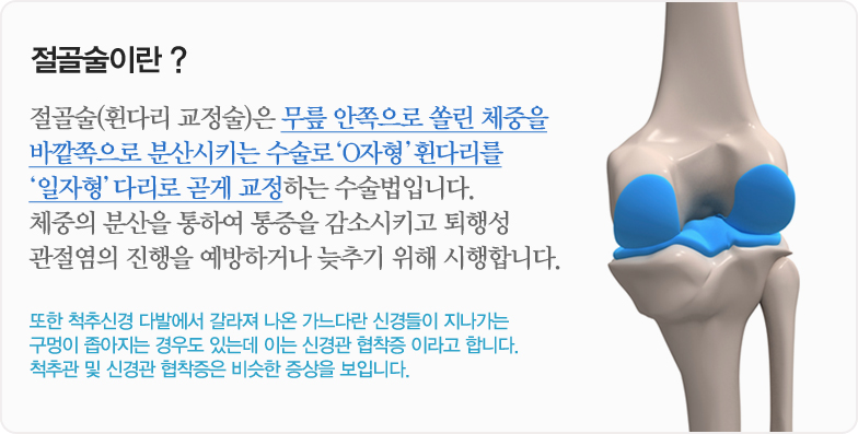 절골술이란 ? 절골술(휜다리 교정술)은 무릎 안쪽으로 쏠린 체중을 바깥쪽으로 분산시키는 수술로 ‘O자형’ 휜다리를 ‘일자형’ 다리로 곧게 교정하는 수술법입니다. 체중의 분산을 통하여 통증을 감소시키고 퇴행성 관절염의 진행을 예방하거나 늦추기 위해 시행합니다. 또한 척추신경 다발에서 갈라져 나온 가느다란 신경들이 지나가는 구멍이 좁아지는 경우도 있는데 이는 신경관 협착증 이라고 합니다. 척추관 및 신경관 협착증은 비슷한 증상을 보입니다.