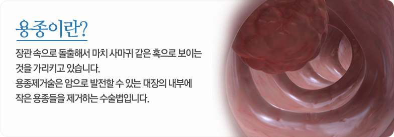 용종이란? 장관 속으로 돌출해서 마치 사마귀 같은 혹으로 보이는 것을 가리키고 있습니다.